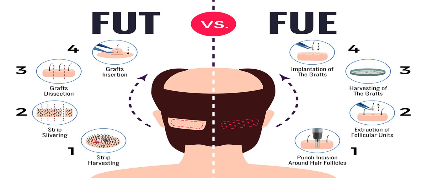 Methods of hair transplantation fut vs fue poster with infographic elements on white background vector illustration